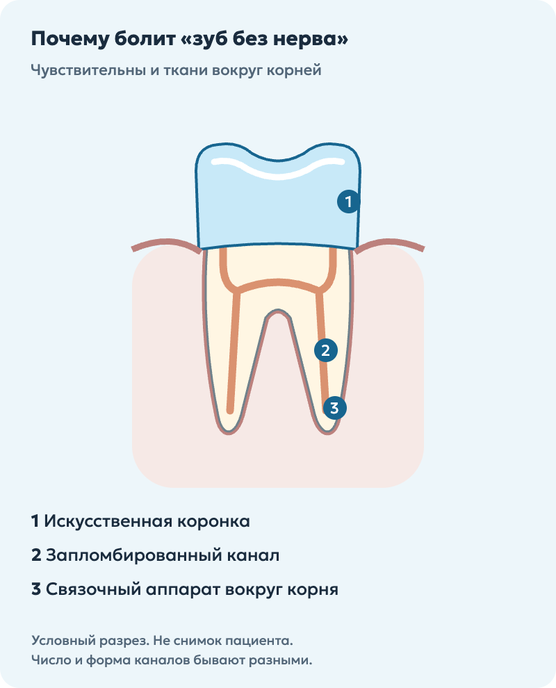 Условный разрез зуба с коронкой и запломбированными каналами; чувствительные ткани окружают корни.