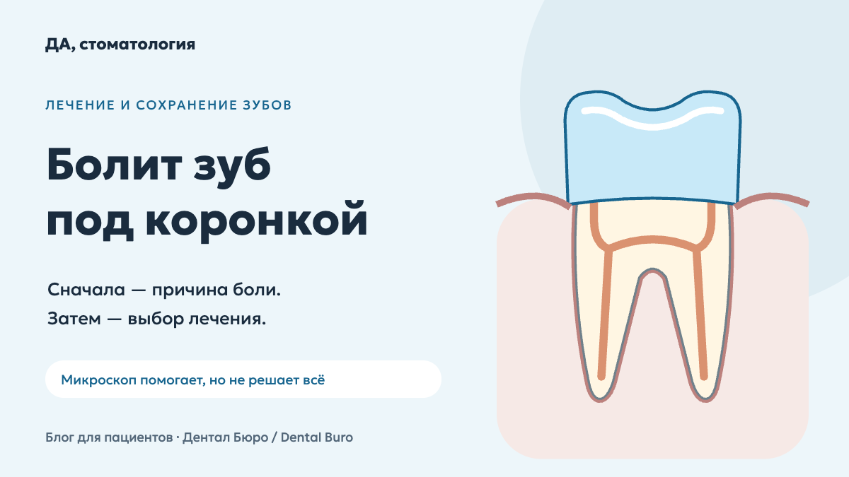 Схематичный зуб под коронкой в разрезе — обложка статьи о причинах боли.